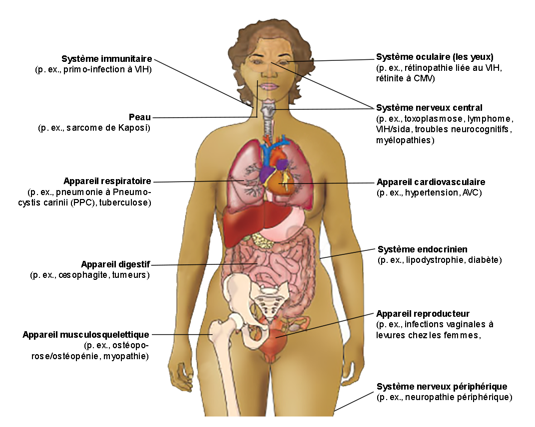 Figure 2.3 Exemples de diagnostics qui affectent différents systèmes de l’organisme chez les personnes vivant avec le VIH. Lire la description ci-dessous.